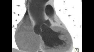 Cardiac: Dilated aortic root and sinuses of Valsalva (4 of 10)