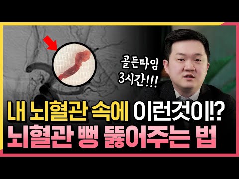 치명적인 뇌졸중, 이제 수술없이 막힌 뇌혈관 뚫어… | 혈전제거술