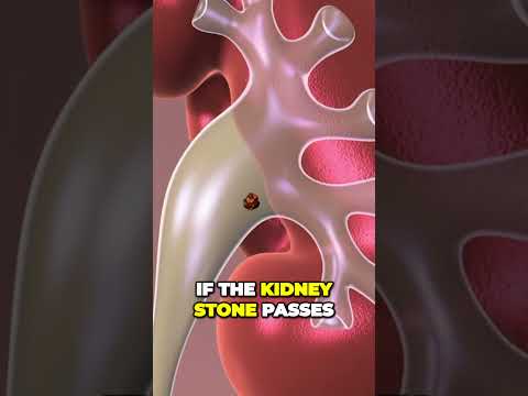 Kidney Stone Passing - Observation  #healthandwellness