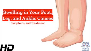 Unraveling Foot, Leg, and Ankle Swelling: What's Behind the Bloat?