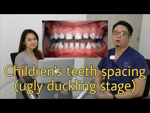 Why do my kid's teeth have spacing? (Ugly duckling stage)