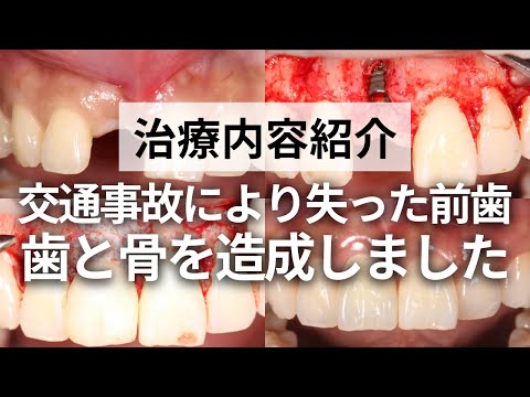 【治療紹介】歯と骨を造る！交通事故で失った前歯を綺麗にしました