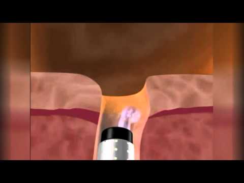 Prostate Laser Vaporization for Prostate Enlargement