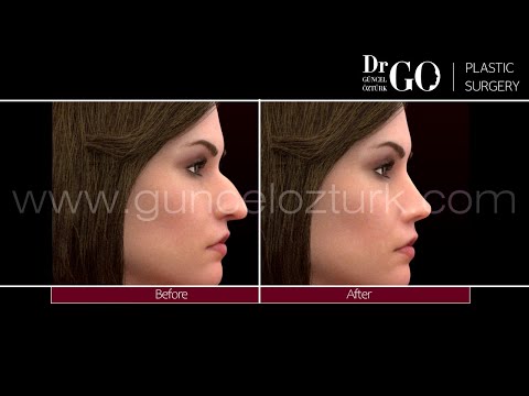 Operación de Rinoplastia de Preservación de Bajada y Empuje hacia Abajo. Guncel Ozturk M.D. #DRGO