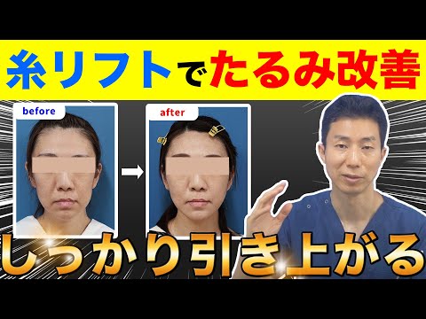 【糸リフト】たるみはどのくらい引き上げる？｜リフトアップ効果を徹底解説