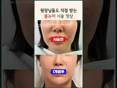 원장님도 받는 국산 써마지 볼뉴머 리프팅 | 탄력 타이트닝 얇은 피부 전후 영상 비교 asmr #modsclinic #모즈클리닉 #볼뉴머 #써마지