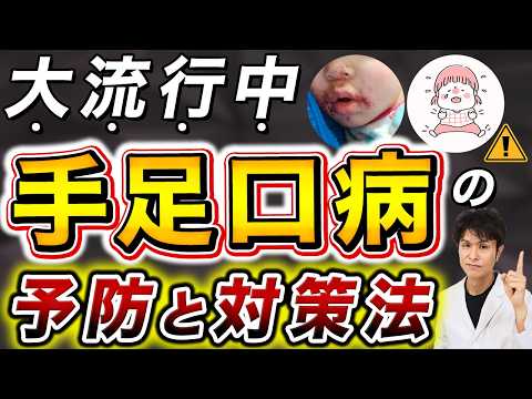 手足口病が子供も大人にも大流行中！皮膚科医が教える症状・対策・治療法・感染経路