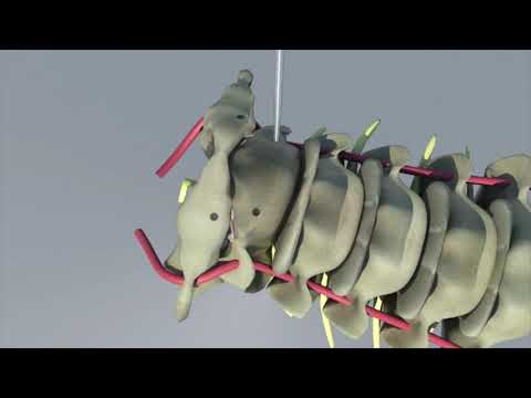 Ant. retropharyngeal cage distraction w/ atlantoaxia plate-screw fix. for basilar invagination ...