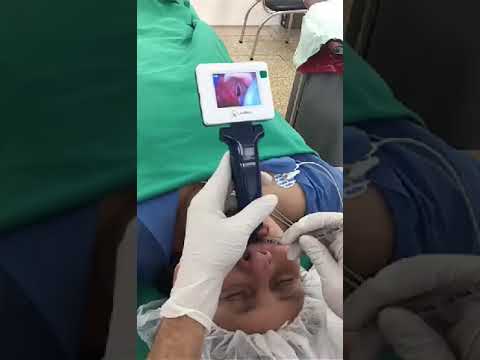 Video Laryngoscope: Intubation in Adult