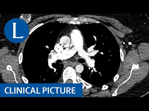 Pulmonary embolism with thrombus-in-transit across a patent foramen ovale