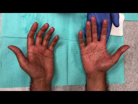 Botox palm injections for hand sweating (hyperhidrosis)