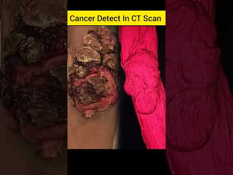 Cancer Detect In CT Scan