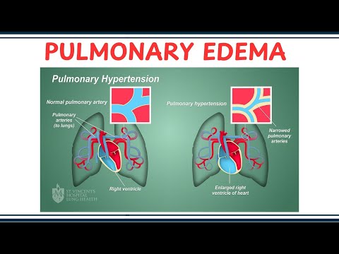 Pulmonary Edema – Causes, Symptoms, Diagnosis and Treatment