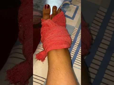 paaye serious injury hoyeceh😔 #shortsvideo #leginjury #dailyvlog #youtubeshorts #viralvideo