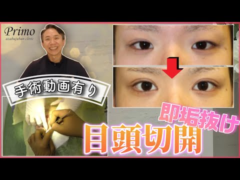 目頭切開で即垢抜け！☆★手術動画有り・プリモ麻布十番クリニック☆★