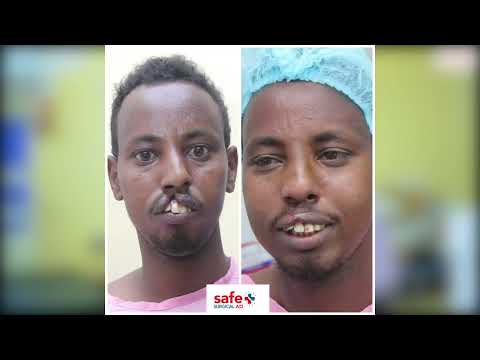 Cleft lip & palate and Pediatric eye camp in Wajir county referral hospital