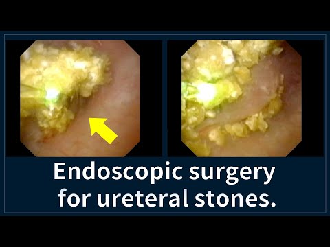 Transurethral endoscopic treatment (TUL) for kidney and ureteral stones