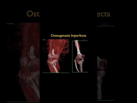 Osteogenesis Imperfecta