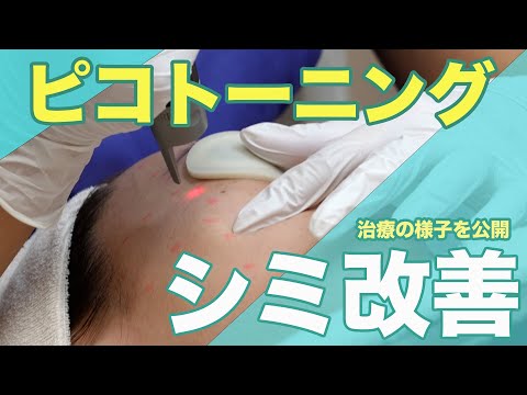 【施術動画】本気のシミ治療！ピコトーニングの効果