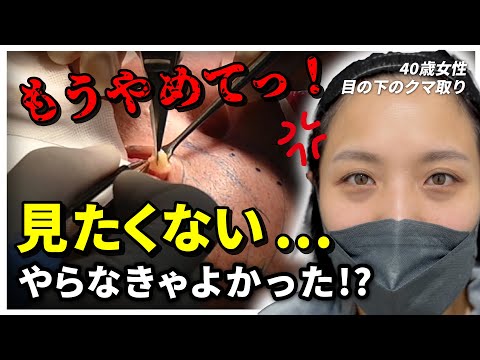 【クマ治療】40歳女性が初の美容整形！１ヶ月後「見たくないっ！」と言った理由とは？Dr.大川隆一朗の美魔女コーディネート【目の下の切らないクマ・たるみ取り】