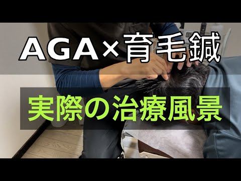 【AGA×育毛鍼】実際の治療風景を公開/無料体験・無料相談　実施中！！ご連絡下さい！！