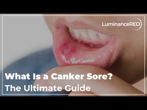 What Is a Canker Sore? The Ultimate Guide