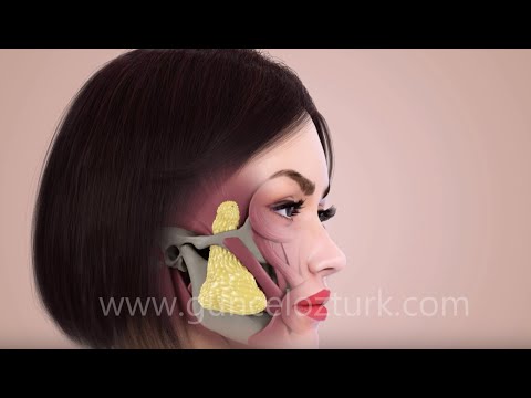 Bichectomy (Fat Removal From The Cheek) - Nefertiti Cheek -   How is it done? Guncel Ozturk, MD-