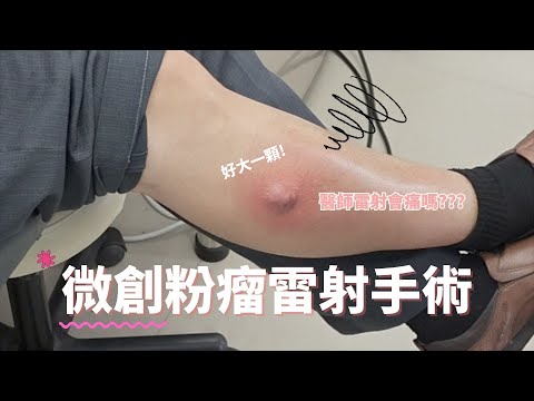 微創粉瘤雷射手術、好大一顆!雷射會痛嗎-極緻美型·文心極緻美型皮膚科診所整形手術-林子鈞醫師：台中粉瘤_粉瘤手術_微創粉瘤_粉瘤健保