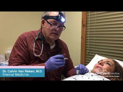 Mole Removal on Chin using Radiofrequency - Reno Sparks MedSpa - Dr. Calvin Van Reken