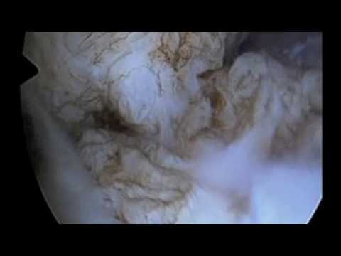 Myomectomy Hysteroscopic with Versapoint & removal by forceps