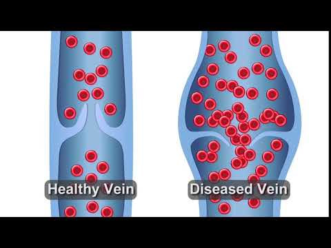 Refluxing Vein Animation