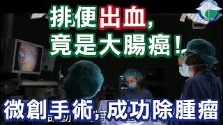 微創手術-微創腹腔鏡自然孔手術