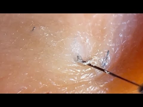 【毛抜き】【埋没毛】見ててちょっとイラつく毛抜きV log【hair remove】