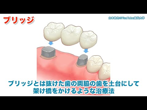 ブリッジとインプラントで迷っています_富山県高岡市やまもと歯科