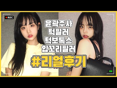 [리얼후기] 윤곽주사 턱필러 턱보톡스 입꼬리필러 전후비교/Q&A/시술설명