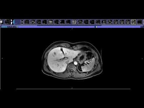 How to read Liver Donor CT/MRI