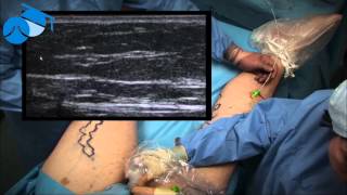 Endovenous Laser Ablation (EVLA) of Great Saphenous Vein - varicose veins