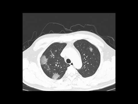 Chest CT findings in COVID-19