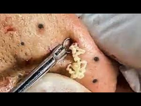 Large Blackheads  | Whiteheads Extraction