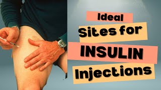 Insulin Injections: Ideal Sites & Rotation   #diabetescare