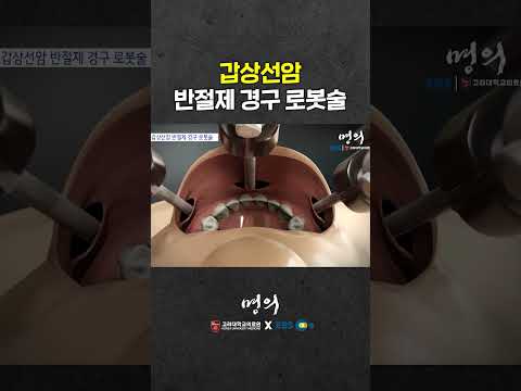 입 안으로 접근하는 갑상선암 로봇수술