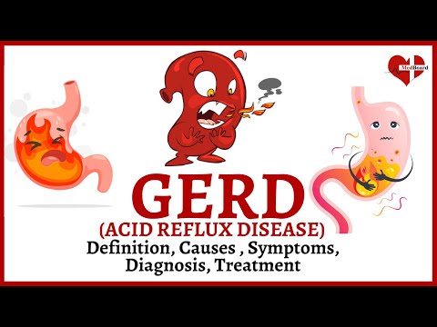 What is GERD (Acid Reflex) | Easy Overview of GERD (Acid reflux Disease)