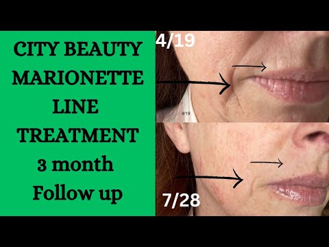 CITY BEAUTY MARIONETTE LINE TREATMENT 3 MONTH FOLLOW UP / BEAUTY OVER 50