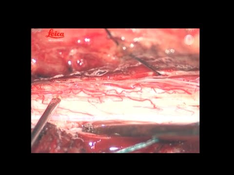 Dorsal root entry zone lesion: nuances of the technique and long-term results