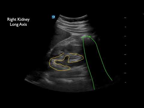 Ureterolithiasis at the Ureterovesical Junction (UVJ) with Twinkle Artifact