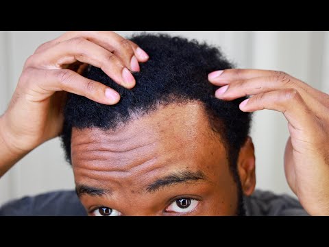 Hair Transplant Week 34 (Final Update)