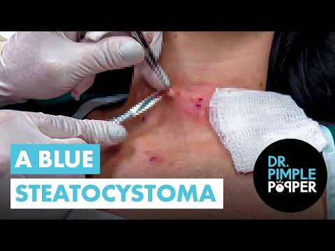 A Blue Steatocystoma