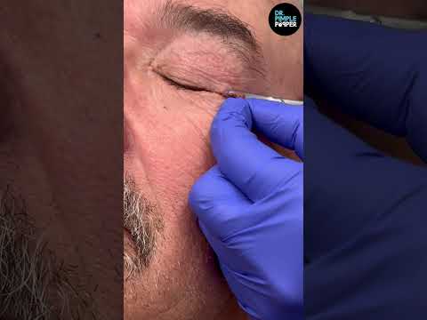 Eye Skin Tags