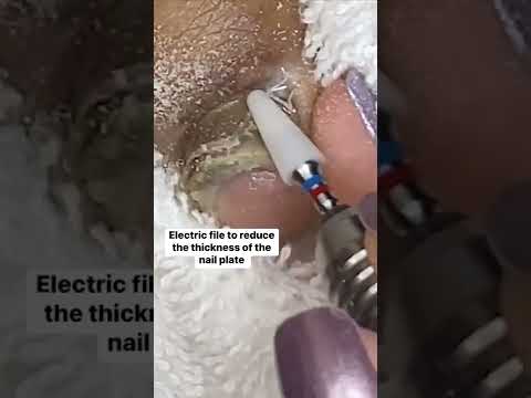 Inside this professional's process of #cleaning impacted #toenails. #pedicure