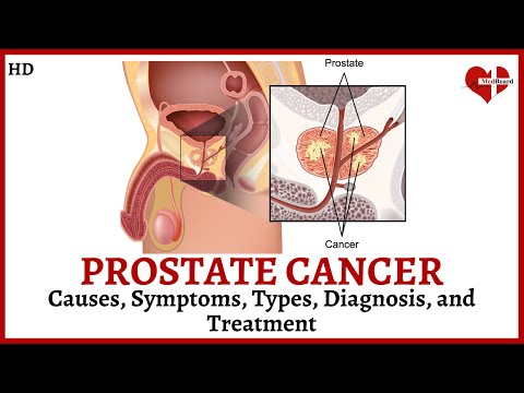 What is Prostate Cancer? | Causes, Types, Symptoms, Diagnosis and Treatment